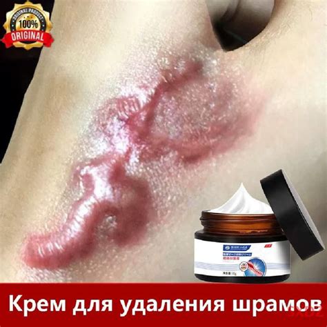 Препараты для удаления шрамов на руке