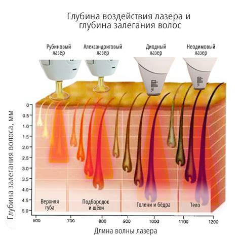 Принцип работы аппарата для лазерной эпиляции