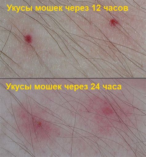 Причина возникновения зуда от укуса мошки