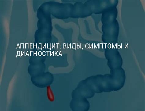 Причины возникновения аппендицита