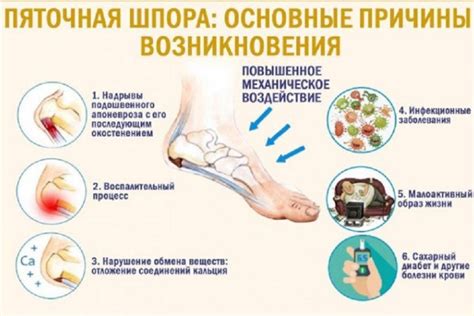 Причины возникновения шпоры на боковой стороне стопы
