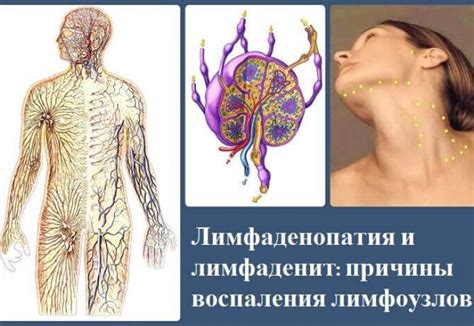 Причины воспаления лимфоузлов