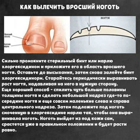 Причины врастания ногтя и его симптомы