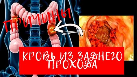 Причины выделений из заднего прохода