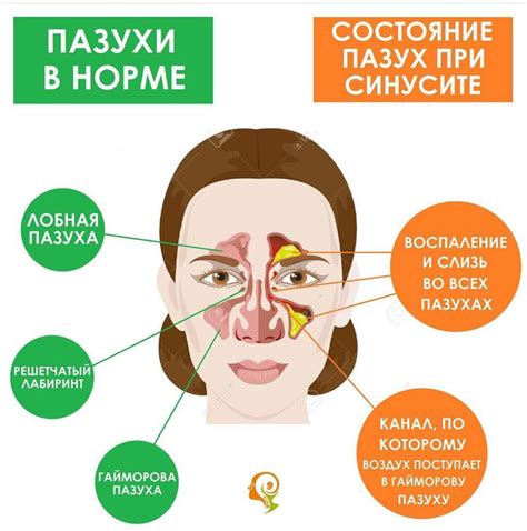 Причины заболевания околоносовых пазух