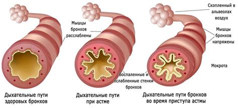 Причины и развитие астмы
