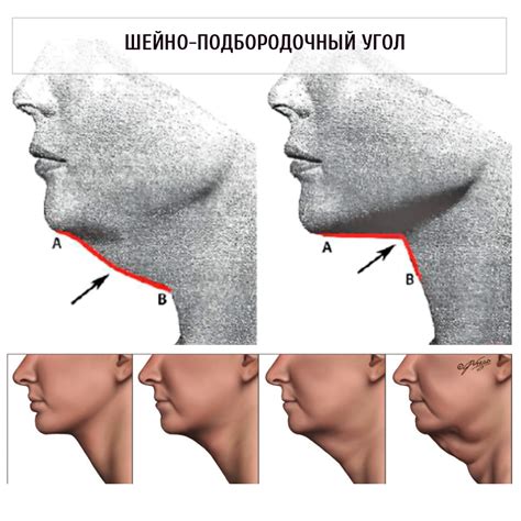 Причины образования второго подбородка у худых людей