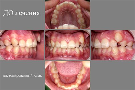 Причины острой формы клыков