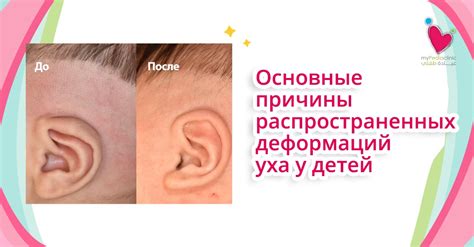 Причины оттопыренных ушей у детей