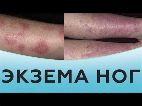 Причины потери чувствительности кожи на ноге