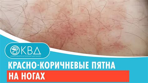 Причины появления красных пятен и зуда на ногах