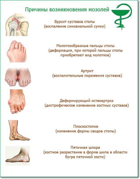 Причины появления мозолей