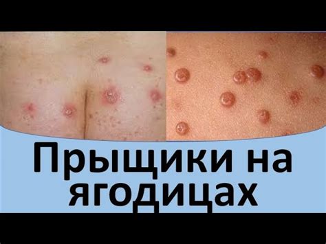 Причины появления прыщей на ляшках
