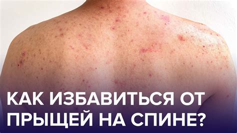 Причины появления прыщей на плечах у подростков