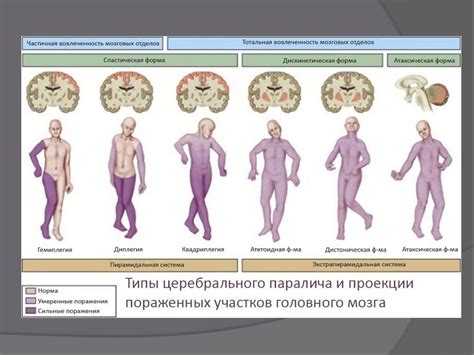 Причины развития паралича ног