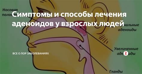 Причины удаления аденоидов