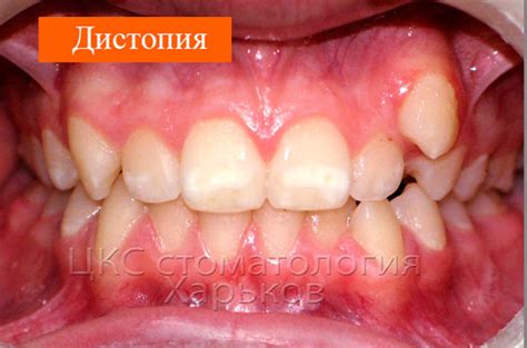 Проблема острой формы клыков