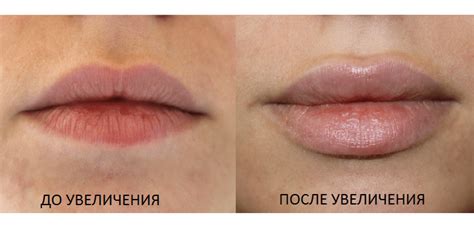 Проблема увеличенных губ