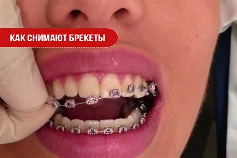 Проверка готовности брекетов к снятию