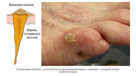 Профилактика возникновения мозоли на пальце ноги