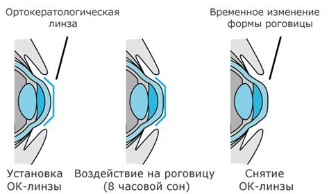 Профилактика и предупреждение минус 4 диоптрий