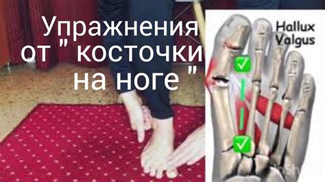 Профилактика косточки на ноге: рекомендации от врачей
