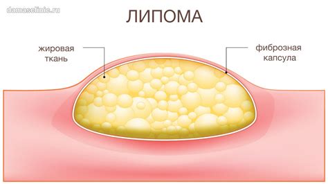 Профилактика образования липомы на шее