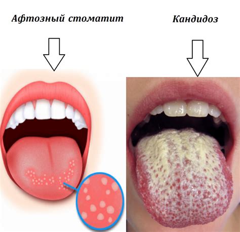 Профилактические меры и безопасные способы избавления от шишки во рту