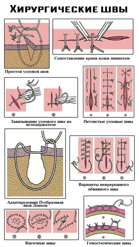 Процесс и применение накладывания швов