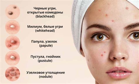 Прыщи по бокам лица: