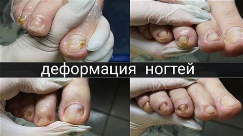 Психологический фактор в росте ногтей на левой руке
