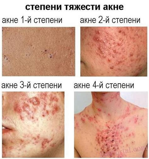 Развитие акне и прыщей