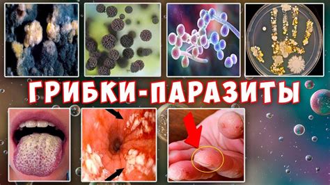 Развитие инфекций и грибковых заболеваний