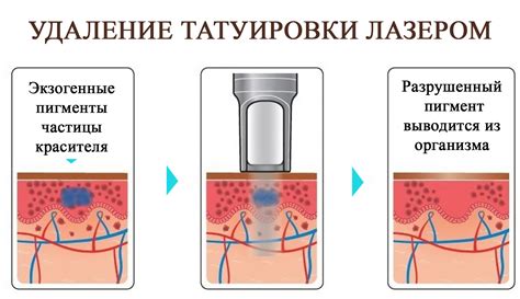 Раздел 3: Механическое удаление татуировки путем шлифования верхнего слоя кожи