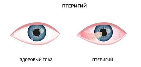 Различные заболевания глаз