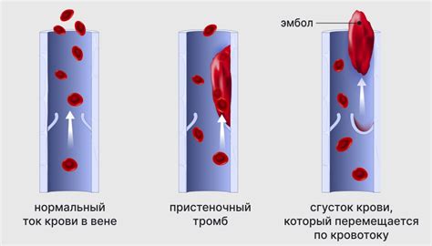 Разрежение кровеносных сосудов