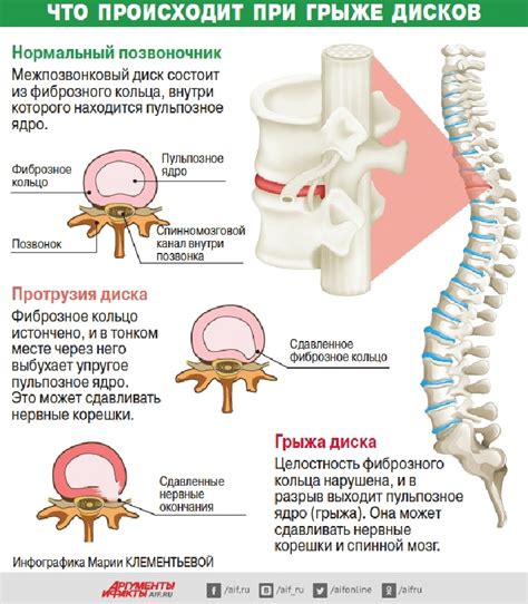 Раннее лечение грыж позвоночника