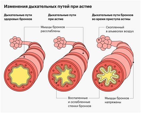 Ранние признаки астмы