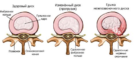 Ранние признаки грыжи позвоночника