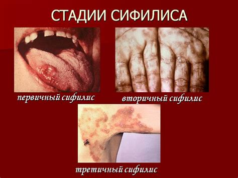 Распространенные симптомы сифилиса