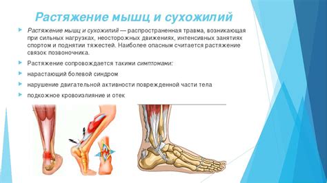 Растяжение мышц и сухожилий