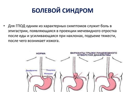 Рекомендации по питанию при грыже пищевода