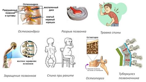 Риск нарушения целостности позвоночника