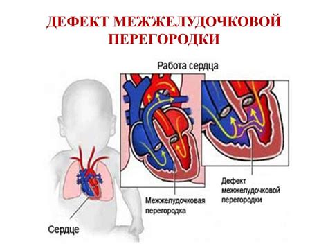 Рост ДМЖП у детей: что это такое и каковы его последствия