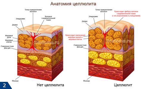 Сауна и другие процедуры для избавления от целлюлита на ногах над коленями