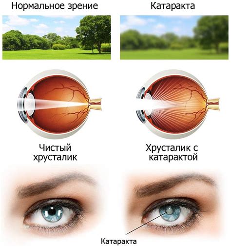 Сауна и катаракта – важность сохранения зрения