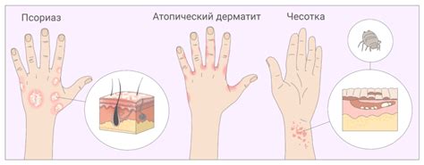 Сахарный диабет и кожный зуд