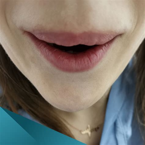 Секреты удаления филлера из скул: эффективные методы
