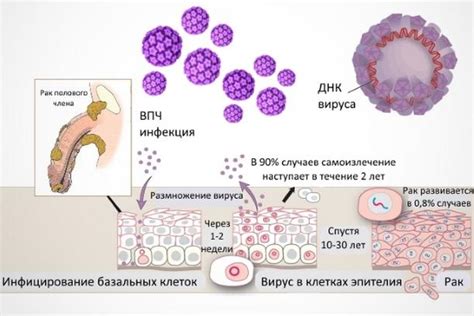 Симптомы ВПЧ у мужчин
