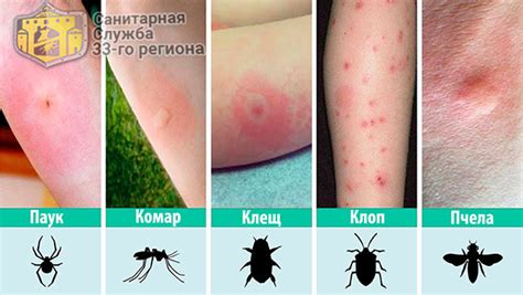 Симптомы аллергии на постельных клещей и возможные осложнения